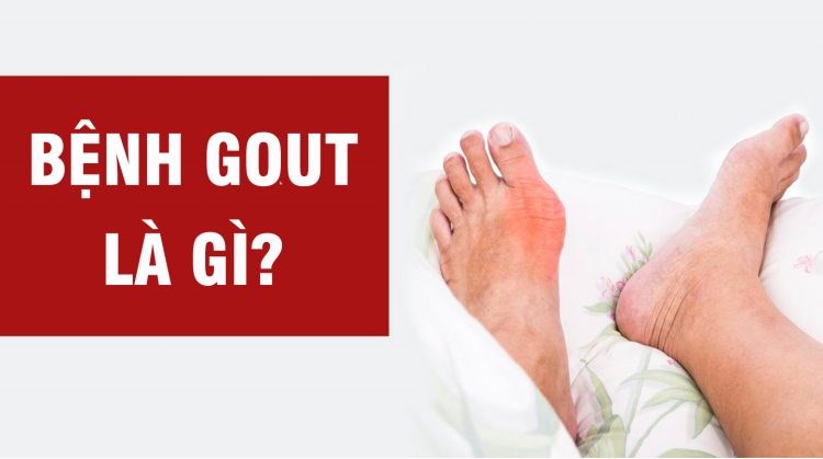 Bệnh gout là gì? Nguyên nhân dẫn đến gout?