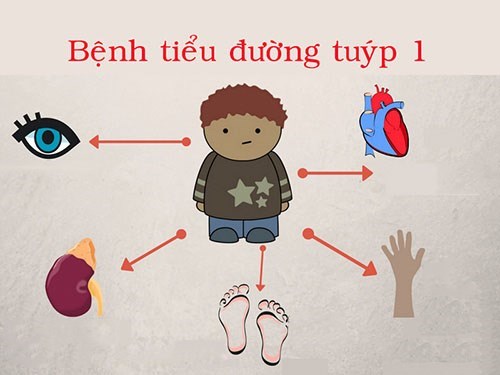 Tiểu đường tuýp 1: Biến chứng, chẩn đoán và điều trị