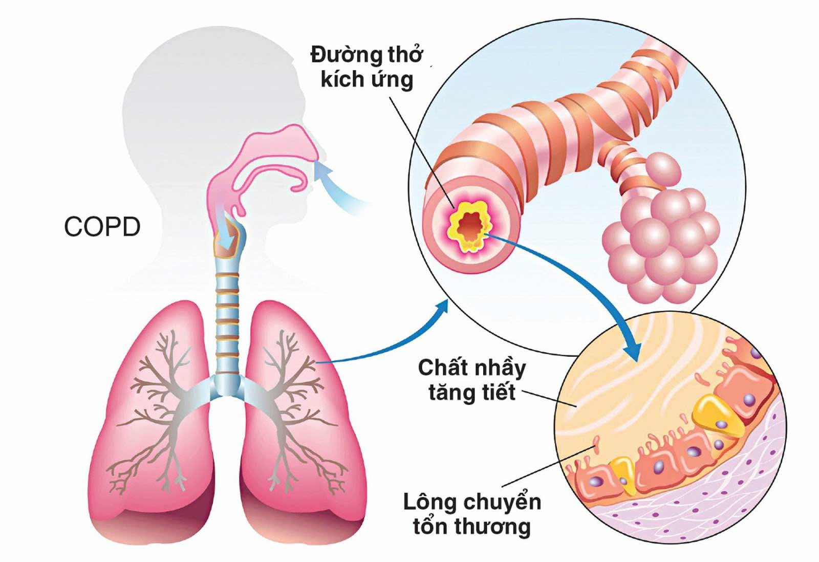 Cơ chế hình thành bệnh phổi tắc nghẽn mạn tính